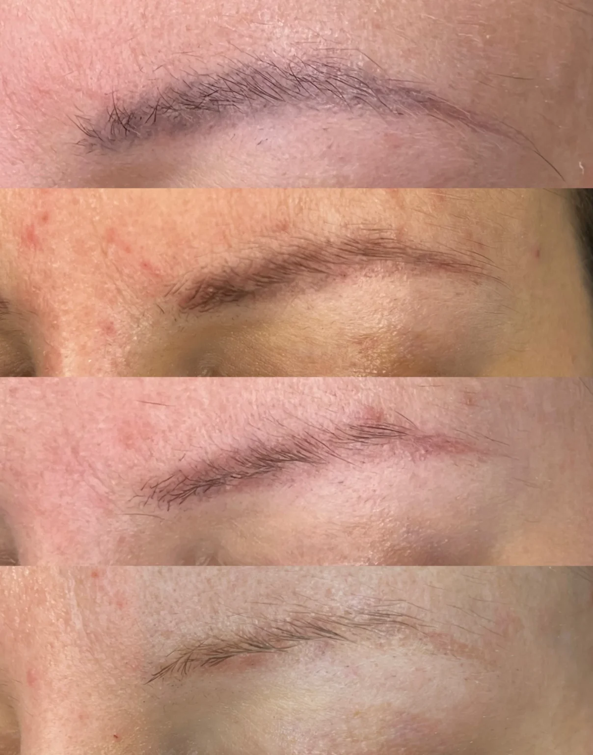 Permanent Make Up & Tattoo Removal