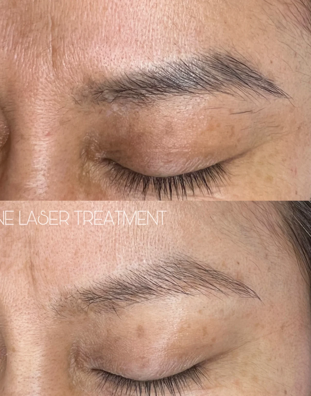 Permanent Make Up & Tattoo Removal